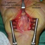 Operazione per correggere la sindrome del tunnel carpale