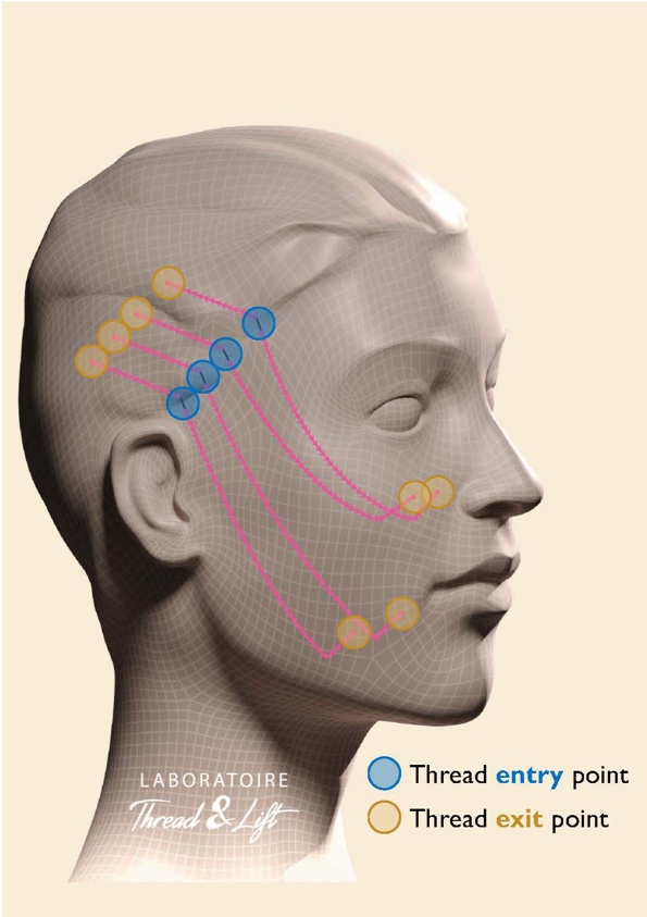 Lifting non chirurgico con fili di trazione a Napoli